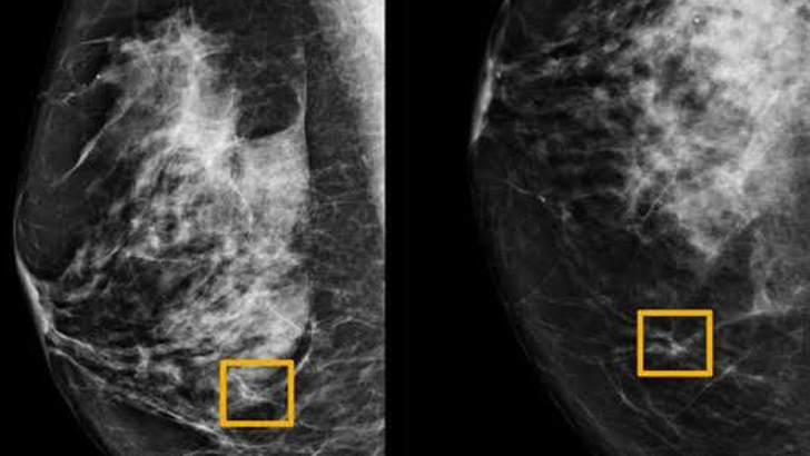 স্তন ক্যান্সার শনাক্তে গুগল এআইয়ের বিস্ময়কর সফলতা