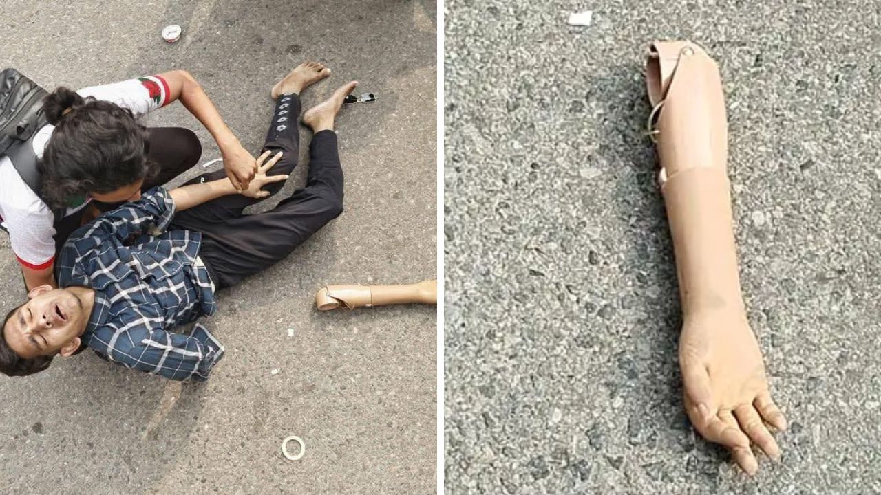 পুলিশের লাঠিচার্জ সহ্য করতে না পেরে কৃত্রিম হাত রেখেই পালিয়ে গেলেন জুলাই যোদ্ধা