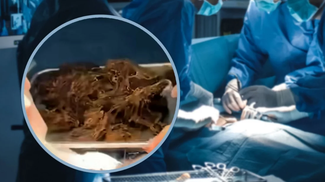 ৬ বছর ধরে চুল খাচ্ছিল কিশোরী, পেট থেকে বের হলো ২ কেজি ‘চুলের গোলা’