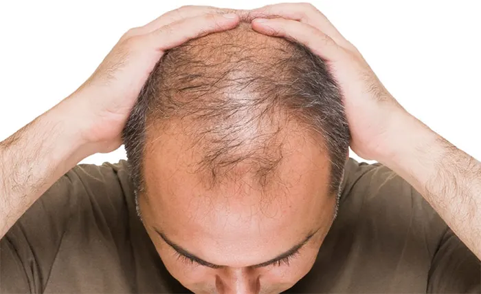 ভারতে টাক মাথায় চুল গজাতে গিয়ে ২ প্রকৌশলীর মৃত্যু